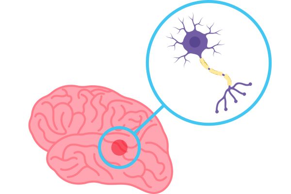 Nguyên nhân bệnh Parkinson ở người lớn tuổi